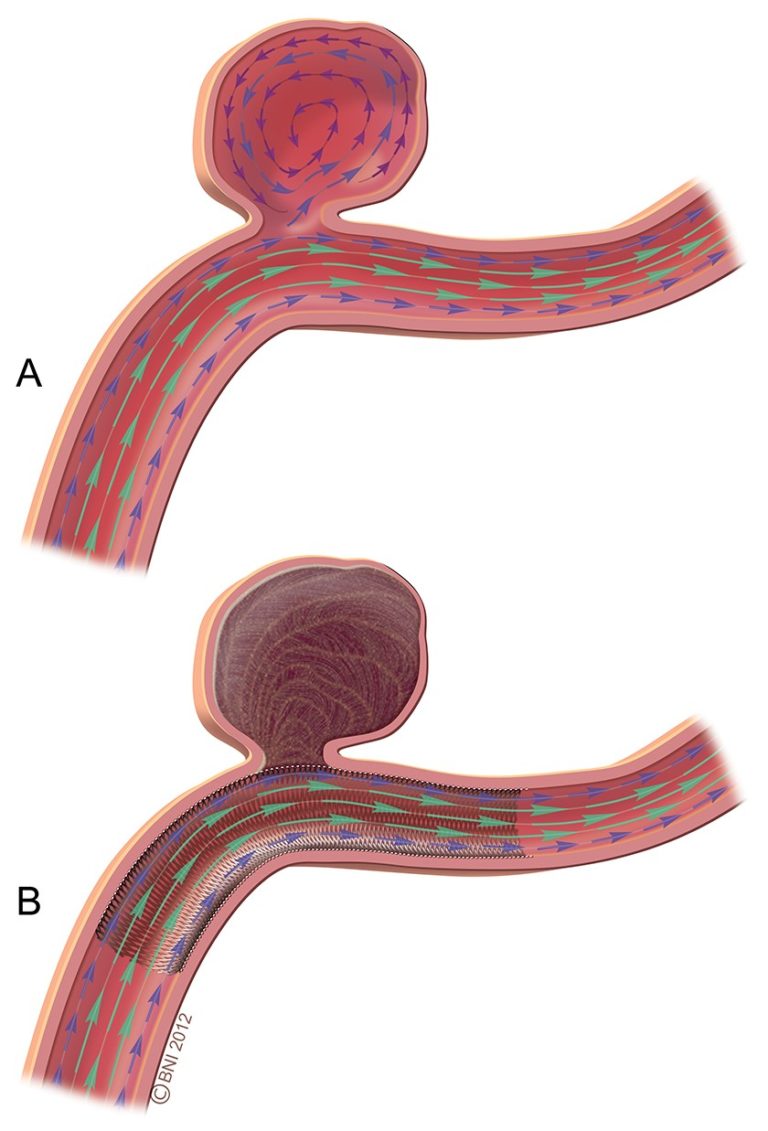 What are my treatment options? Brain Aneurysms