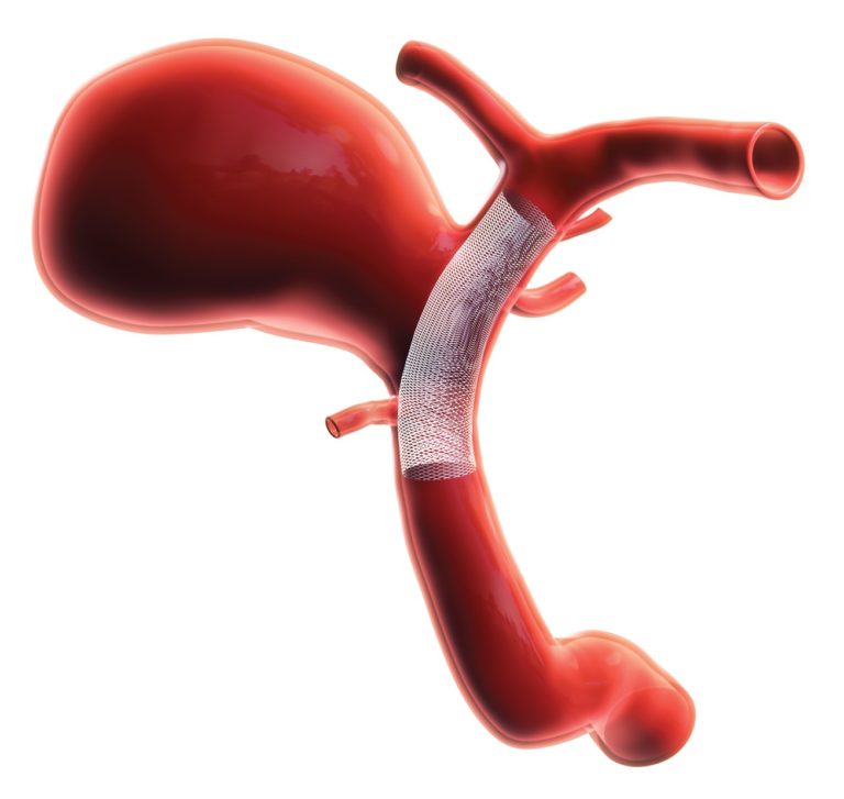 What are my treatment options? Brain Aneurysms