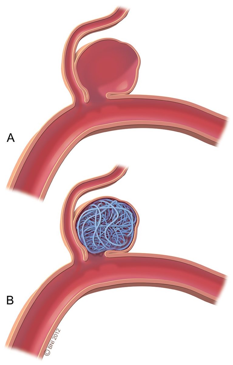 What are my treatment options? | Brain Aneurysms